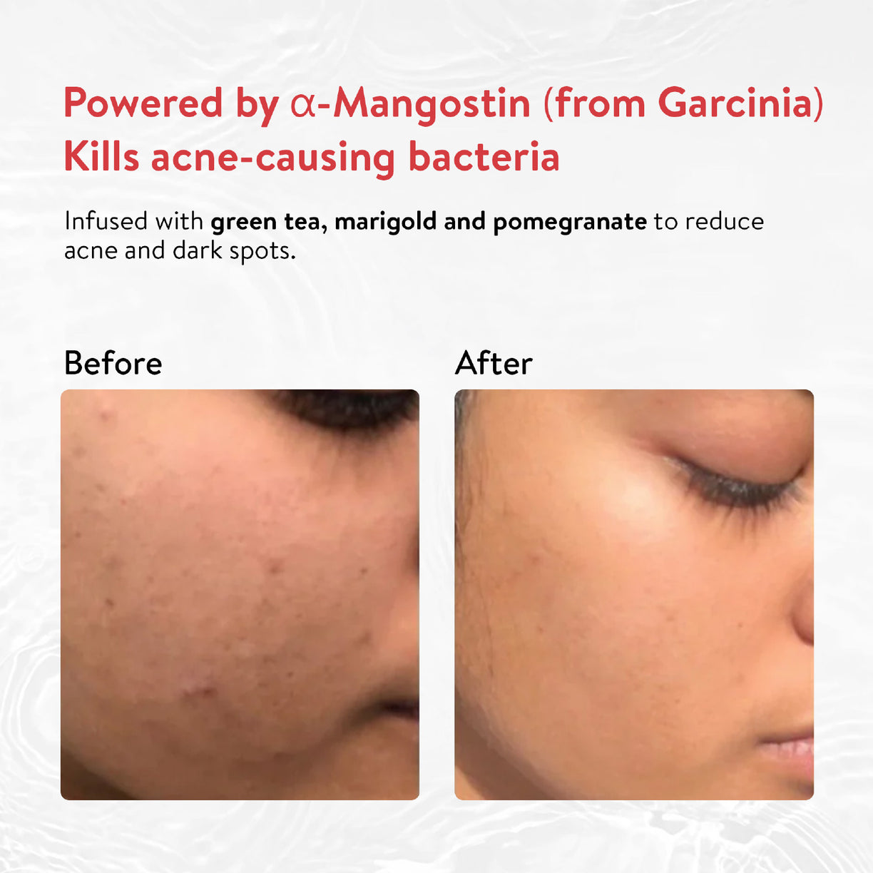 Ayouthveda Acne Enemy Face Wash Gel for Acne & Pimples | Sulfate-Free - 100ml